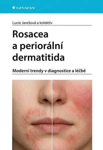 Rosacea a periorální dermatitida - Lucie Jarešová