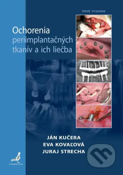 Ochorenia periimplantačných tkanív a ich liečba - Juraj Strecha, Eva Kovaľová, Ján Kučera - kniha z kategorie Stomatologie a dentální hygiena