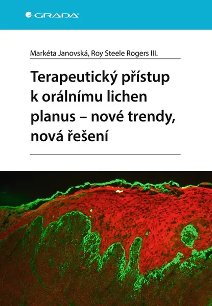 Terapeutický přístup k orálnímu lichen planus - nové trendy, nová řešení, Janovská Markéta