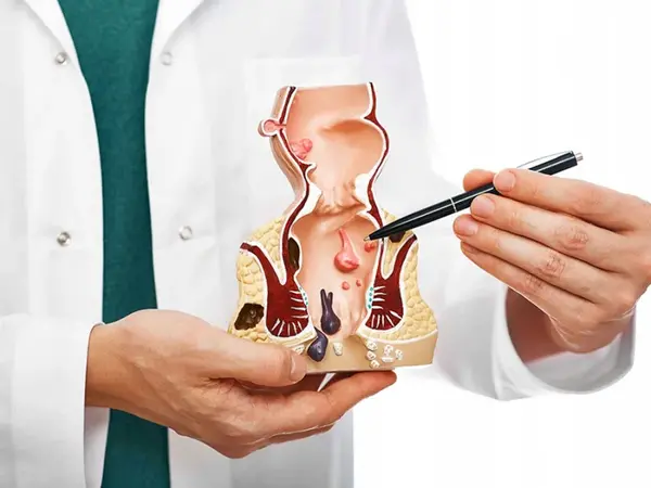 Prierezový model konečníka, hemeroidy (zväčšený) s patológiami