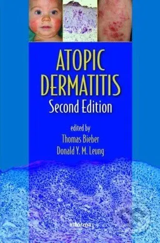 Atopic Dermatitis (Second Edition) - Thomas Bieber, Donald Y.M. Leung - kniha z kategorie Odborné a naučné