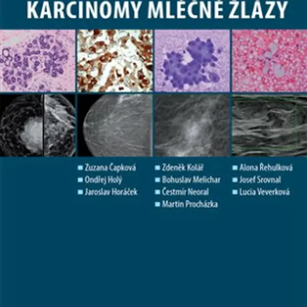 "Triple" negativní karcinomy mléčné žlázy - Markéta Kolečková