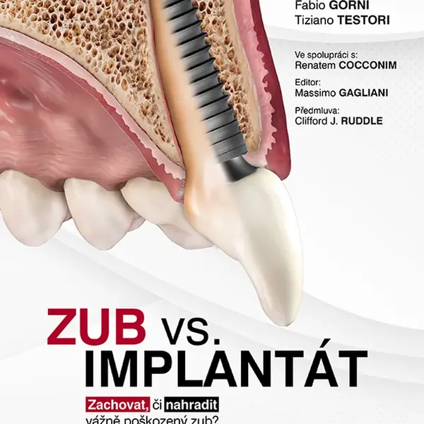 Zub vs. implantát, Bertani Pio