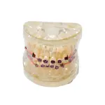 Model chrupu, zubných implantátov so zubným strojčekom, transparentný